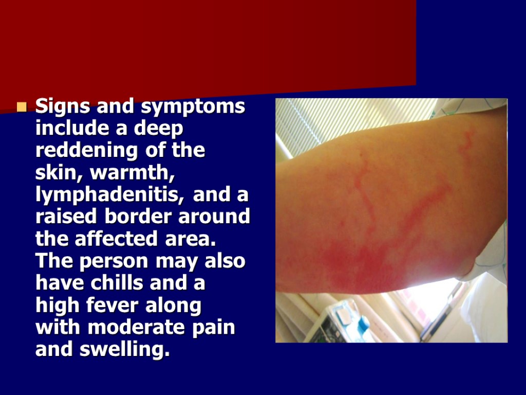 Signs and symptoms include a deep reddening of the skin, warmth, lymphadenitis, and a